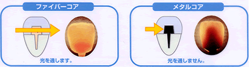ファイバーコアは光を透過します。 | 市ヶ谷・歯医者