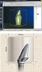 ロセラRオールセラミック(ジルコニア)システム | 市ヶ谷・歯医者