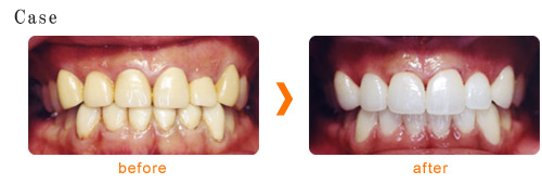 ホームホワイトニング | 市ヶ谷・歯医者