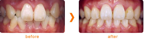 矯正治療後の当院の患者様 | 市ヶ谷・歯医者