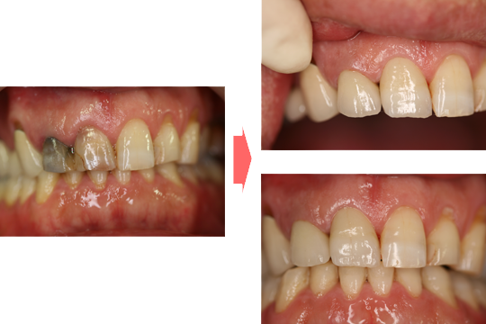 実際の治療症例 | 市ヶ谷・歯医者