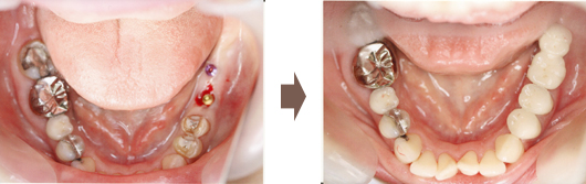 インプラントの利点はどういうところですか? | 市ヶ谷・歯医者