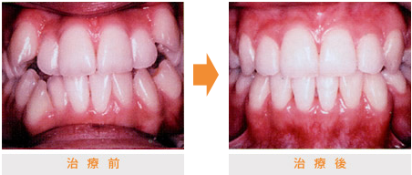 不正咬合の治療例 | 市ヶ谷・歯医者
