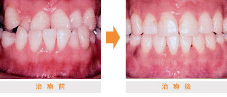 不正咬合の治療例 | 市ヶ谷・歯医者
