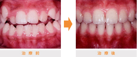 不正咬合の治療例 | 市ヶ谷・歯医者