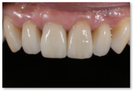 審美歯科の症例 | 市ヶ谷・歯医者