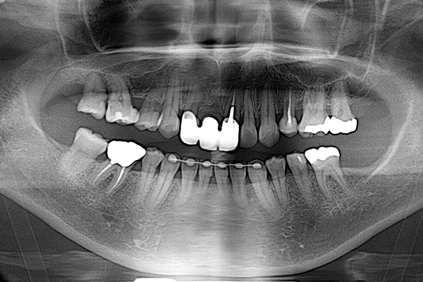 審美歯科の症例 | 市ヶ谷・歯医者