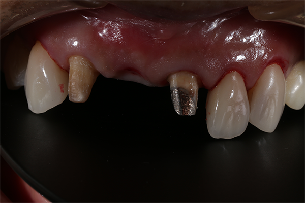 審美歯科の症例 | 市ヶ谷・歯医者