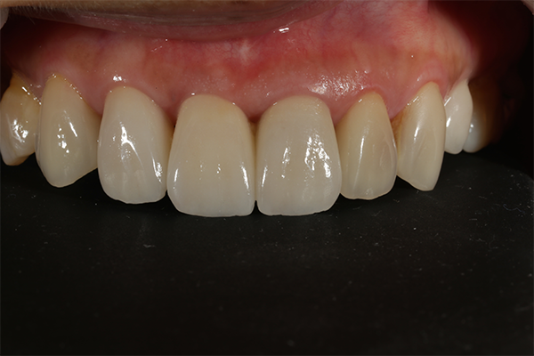 審美歯科の症例 | 市ヶ谷・歯医者