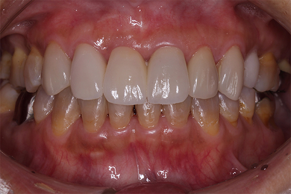 審美歯科の症例 | 市ヶ谷・歯医者