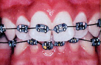 メタルブラケット | 市ヶ谷・歯医者