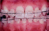 セラミックブラケット | 市ヶ谷・歯医者