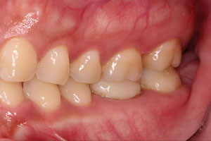 当院でメインテナンスをされて健康な歯を維持されている患者さんの例 | 市ヶ谷・歯医者