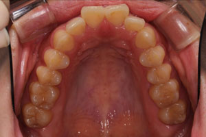 当院でメインテナンスをされて健康な歯を維持されている患者さんの例 | 市ヶ谷・歯医者