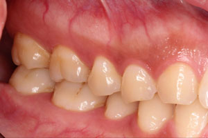 当院でメインテナンスをされて健康な歯を維持されている患者さんの例 | 市ヶ谷・歯医者